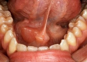 Симптомы воспаления слюнной железы Симптомы воспаления слюнной железы