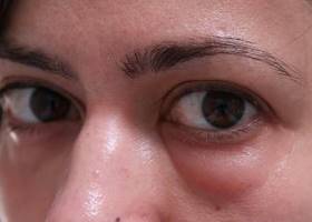 Симптомы Симптомы