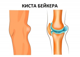 Симптомы кисты Беккера Симптомы кисты Беккера