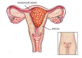 Симптомы пузырного заноса Симптомы пузырного заноса