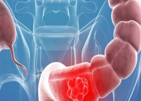 Симптомы рака кишечника Симптомы рака кишечника