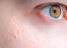 Симптомы Симптомы