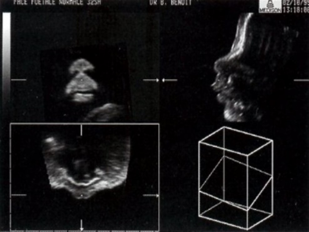 Трехмерное изображение лица плода в 32 недели Трехмерное изображение лица плода в 32 недели