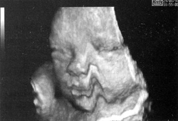 Артефакты, обусловленные движениями плода Артефакты, обусловленные движениями плода