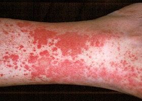 Ангииты кожи фото Ангииты кожи фото