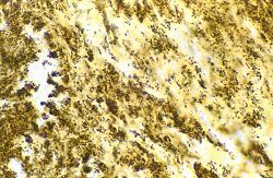 Bartonella henselae Bartonella henselae