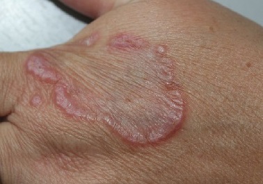 Бляшка кольцевидной гранулемы