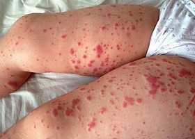 Фото геморрагического васкулита у детей Фото геморрагического васкулита у детей