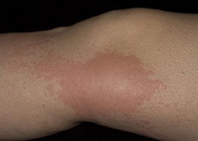 Фото уртикарного васкулита Фото уртикарного васкулита