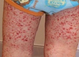 Фото васкулит на ногах Фото васкулит на ногах