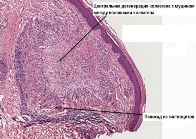 Гистология палисадниковая форма кольцевидной гранулемы