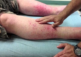 Лечение васкулита на ногах фото Лечение васкулита на ногах фото