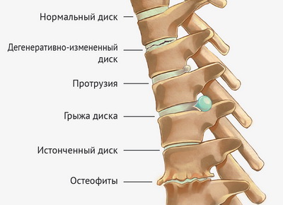 Распространенные проблемы позвоночника Распространенные проблемы позвоночника