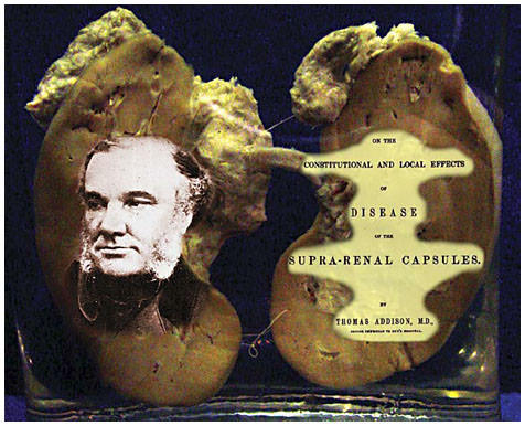 Томас Аддисон и его книга