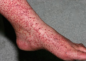 Васкулит фото Васкулит фото