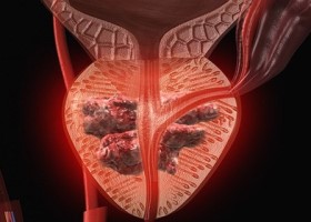 Аденокарцинома предстательной железы Аденокарцинома предстательной железы