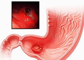 Аденокарцинома желудка Аденокарцинома желудка