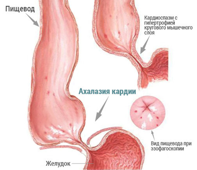 Наглядное изображение ахалазии Наглядное изображение ахалазии