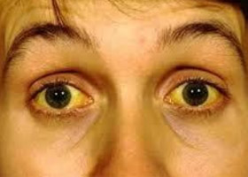 alkogolnyj-gepatit simptomy Алкогольный гепатит