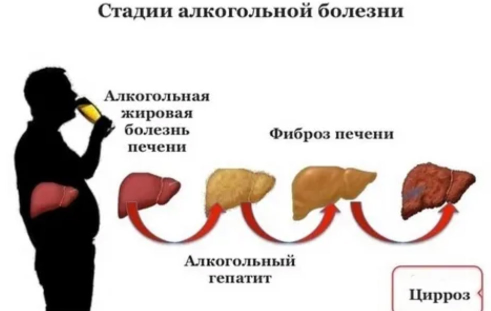 alkogolnyj-gepatit stadii Алкогольный гепатит