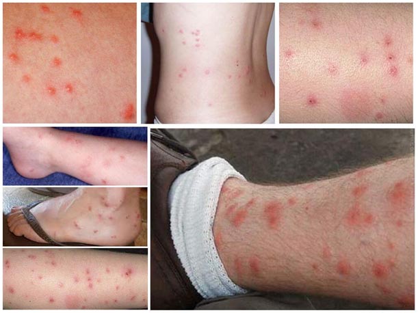 Аллергический дерматит Аллергический дерматит