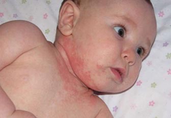 Аллергический дерматит Аллергический дерматит