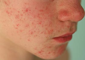 Аллергический дерматит Аллергический дерматит