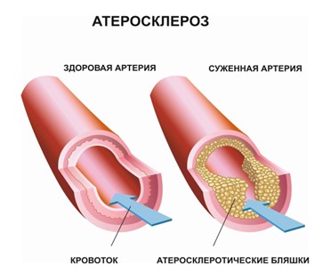 analiz-krovi-na-trigliceridy-03 Атеросклероз
