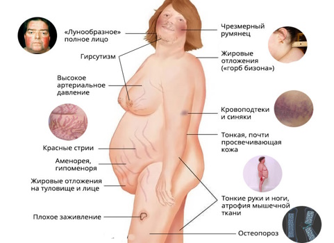 Гиперкортицизм Гиперкортицизм