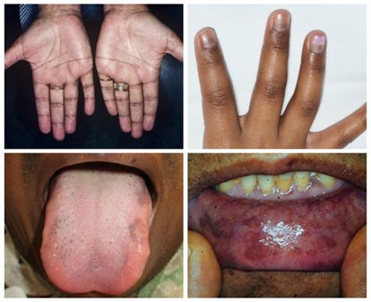 Гипокортицизм Гипокортицизм