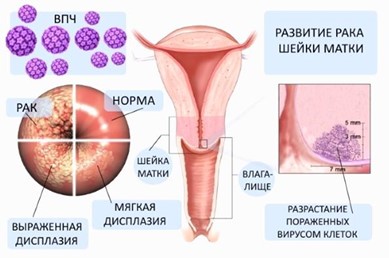 analiz-na-vpch-03 Вирус папилломы человека в гинекологии
