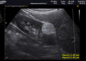 Ангиомиолипома почки Ангиомиолипома почки