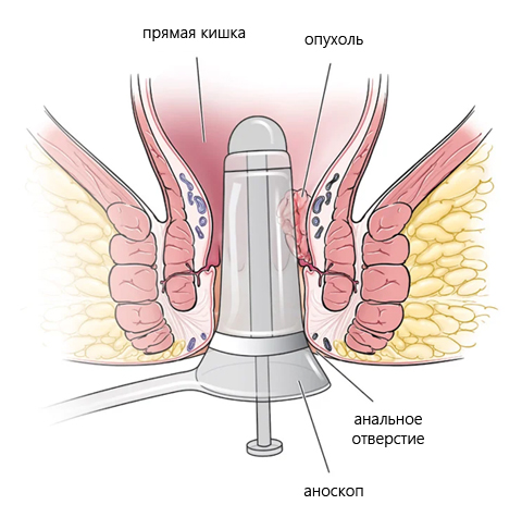 Схема проведения аноскопии Схема проведения аноскопии