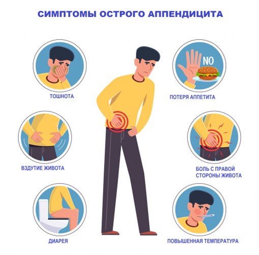 Симптомы острого аппендицита Симптомы острого аппендицита