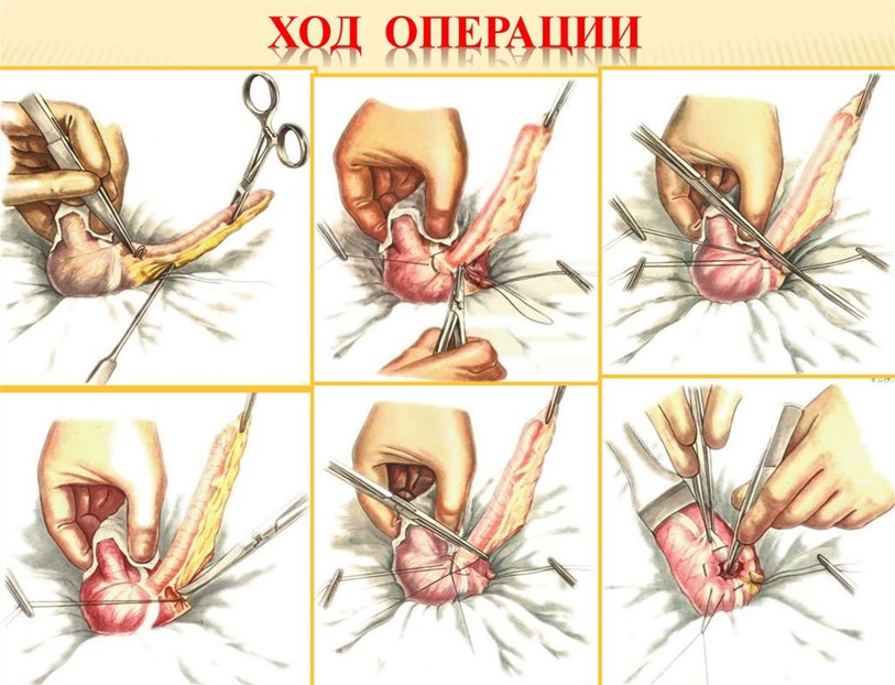 Ход аппендэктомии Ход аппендэктомии