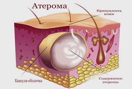 ateroma-2 stroenie Атерома