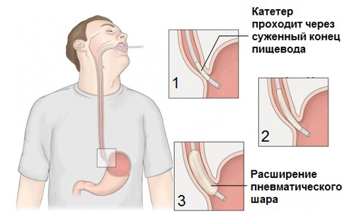 Использование баллонной дилатации Использование баллонной дилатации