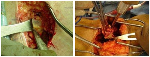 bedrennaya-gryzha operacia Бедренная грыжа