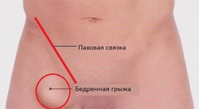 bedrennaya-gryzha pahovaya Бедренная грыжа