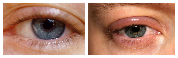 Фото глаз при блефарите Фото глаз при блефарите