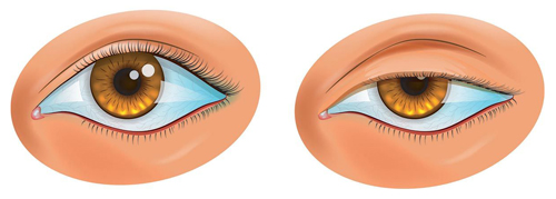 Нормальное состояние века (слева) и блефароптоз (справа) Нормальное состояние века (слева) и блефароптоз (справа)