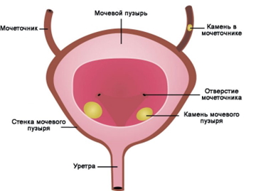 Камни в уретре Камни в уретре