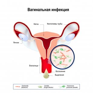 Вагинальные инфекции Вагинальные инфекции