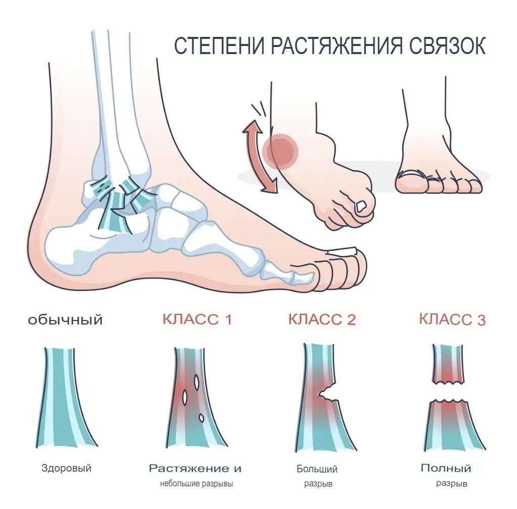 Степени растяжения связок Степени растяжения связок