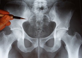 Боль в области копчика Боль в области копчика