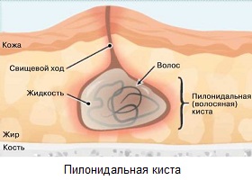 Боль в области копчика Боль в области копчика