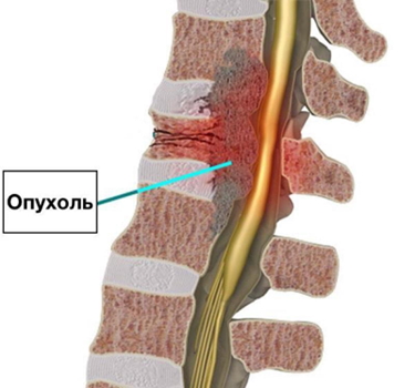 Опухоль в позвоночном столбе Опухоль в позвоночном столбе