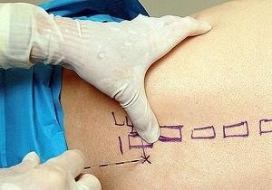 Паравертебральная блокада Паравертебральная блокада