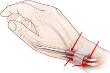 Тендовагинит Тендовагинит