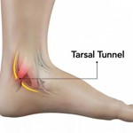 Синдром тарзального канала Синдром тарзального канала
